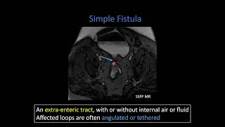 Crohn Disease Part 2 Penetrating Disease and Mesenteric Inflammation [upl. by Zulch]