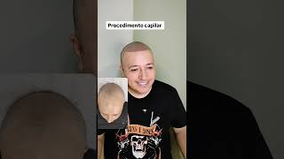 MICROPIGMENTAÇÃO CAPILAR PROCEDIMENTO PARA FALTA DE CABELO O MAIS REALIZADO [upl. by Morey173]