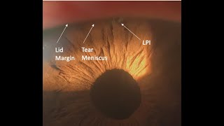 Laser Peripheral Iridotomy Tips and Tricks Malik Y Kahook MD [upl. by Jessamine]