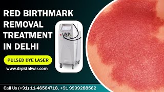 Red Birthmark Removal  Portwine Stain Removal in Delhi India by Pulsed Dye Laser  Dr PK Talwar [upl. by Petras527]