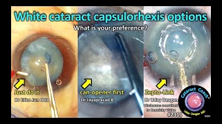 CataractCoach™ 2311 white cataract capsulorhexis options [upl. by Manvel]