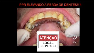 PRÓTESE REMOVÍVEL OCASIONANDO A PERDA DOS DENTES [upl. by Goodill]