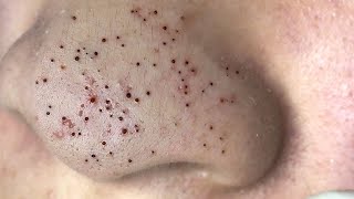 Big Cystic Acne Blackheads Extraction Blackheads amp Milia Whiteheads Removal Pimple Popping  8996 [upl. by Wald380]