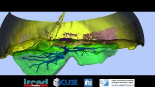 SLAM based Quasi Dense Reconstruction For Minimally Invasive Surgery Scenes  Augumented Reality [upl. by Assira]