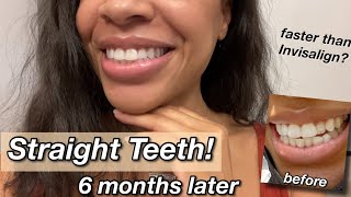 My six month experience with clear aligners  invisalign cheaper option  before and after results [upl. by Cheslie]