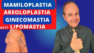 Ginecomastia Lipomastia Mamiloplastia Areoloplastia Dr Jacintho  Cirurgião Plástico [upl. by Lhamaj399]