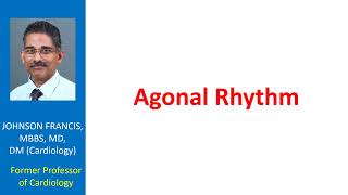 Agonal Rhythm [upl. by Pan]