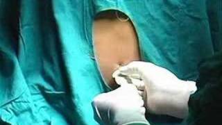 Lumbar Puncture [upl. by Grew]