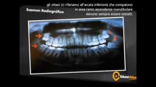 epilessia guarita erano i denti del giudizio [upl. by Leirad592]