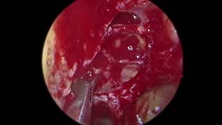 Full Functional Endoscopic Sinus Surgery FESS for sinusitis [upl. by Mcroberts]