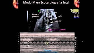 Ecocardiografía fetal Ultrasonido en Modo M para Evaluar el corazón fetal [upl. by Botti509]