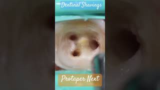 Dentinal Shavings 🔵 Protaper Next ⚪️ atozkidsdental toothisland [upl. by Bordiuk]