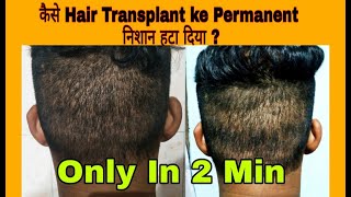 Biggest Problem After Hair Transplant  Scar in Donor Area [upl. by Xymenes]