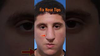 Fix nose tip and get SLIM NOSE viral attractive handsome [upl. by Toby]