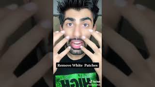 Remove white patches from face [upl. by Westmoreland]