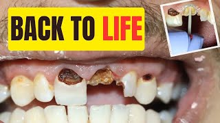 Need a Tooth Implant Alternative See How Dentist save teeth with Crown and Filling [upl. by Aicinod]