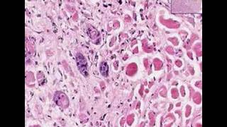 Histopathology TongueSquamous cell carcinoma [upl. by Anividul]