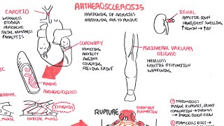 Atherosclerosis  Pathophysiology [upl. by Veradis]