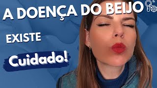 Mononucleose infecciosa  A DOENÇA DO BEIJO  como se pega como se trata e quais sinais e sintomas [upl. by Nieberg]