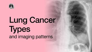 Lung Cancer Types [upl. by Loredana480]