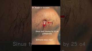 Extraoral sinus tract tracing  Dr Mazen D Doumani dentist اسنان chin اكسبلور centralincisor [upl. by Siul]