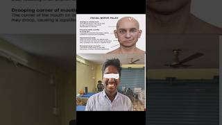 Bells Palsy patients improvement during physiotherapy  shorts physio  bells Palsy [upl. by Enia]