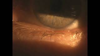 trichiasis misdirected eyelash [upl. by Nella]