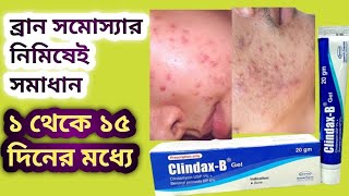 Clindax B Gel কি কাজ করে ব্রান সমস্যা নিমিষেই সমাধান How to Clindax B Gel [upl. by Yajet]