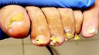 The patient has 6 toes and gets a free pedicure【Xue Yidao】 [upl. by Oiragelo]