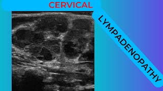 Cervical lymphadenopathy conglomerating nodes on ultrasound scan [upl. by Willem]