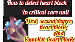 Heart block Atrioventricular block  AV block  ECG of heart block  mobitz type 1 and 2 [upl. by Youlton533]