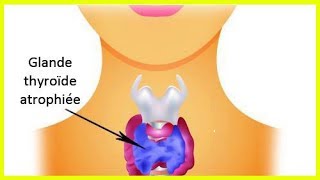 L’hypothyroïdie  comment prendre soin de sa thyroïde [upl. by Ori757]