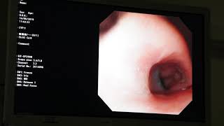 Feeding tube insertion  painless new technique NasoendoscopyDr Chandra Puli FRCP MRCP Gastro UK [upl. by Ambrosane]