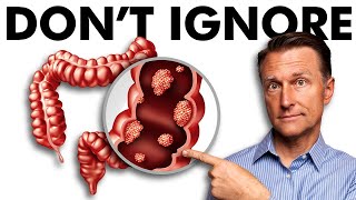 The Early Signs of Colon Cancer You DONT Want to Ignore [upl. by Pettit633]