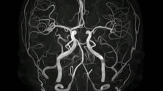 3D MRA TOF of Brain [upl. by Danialah]