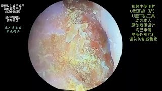 采耳哥Cleaning of tympanic membrane dry films on both sides of a persons ear canal [upl. by Schott]