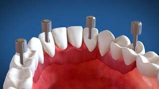 Video Animazione 3D Implantologia dentale a carico immediato Sistema Modulabile [upl. by Dianna]