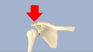 Acromioclavicular Separation [upl. by Codd]