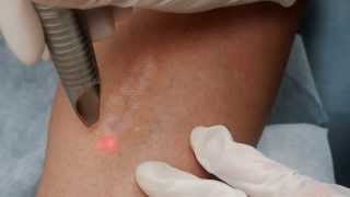 PRODERM Laser Treatment  Scar [upl. by Amri]