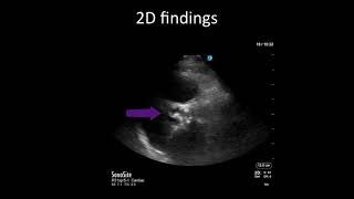 PointofCare Echo Aortic Stenosis vs Sclerosis [upl. by Wash]