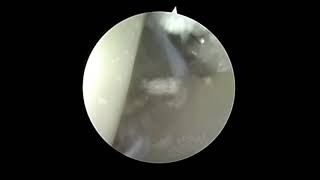 Arthroscopic Gout Removal [upl. by Lemak]