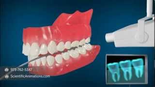 Medical Animation explaining Dental Radiography  Dental XRays [upl. by Sommers]