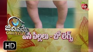 Jeevanarekha child care  Bow Legs  9th November 2016  జీవనరేఖ చైల్డ్ [upl. by Eyahc]