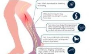 common peroneal nerve disorder and its physiotherapy treatment [upl. by Lindsy]