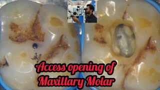 Access opening of Maxillary Molar step by step demonstration  rct for beginners  dental lectures [upl. by Ahola]