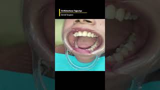 Gap Closure with Zirconia Crowns Dental bridge Midline diastema Doc Taj Cosmetic Dentistry [upl. by Malvina135]