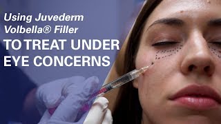 Using Juvederm Volbella® Filler To Treat UnderEye Concerns at ZO Skin Centre [upl. by Ayaladnot]