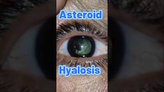 ASTEROID HYALOSIS [upl. by Cosenza696]