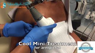 Cool Mini Coolsculpting Treatment for Armpit Fat [upl. by Aneis665]