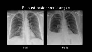 Pleural Effusions [upl. by Synned]